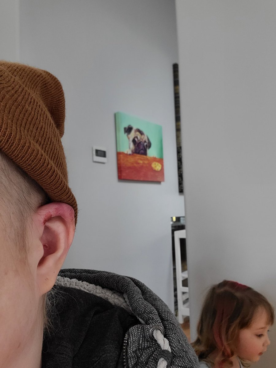LibbyMbc's tweet image. New hematoma had changed shape of ear. Will it stay like this? It's lime an elf ear!!! #hematoma #sideeffects #sideeffucks #metastaticcancer
