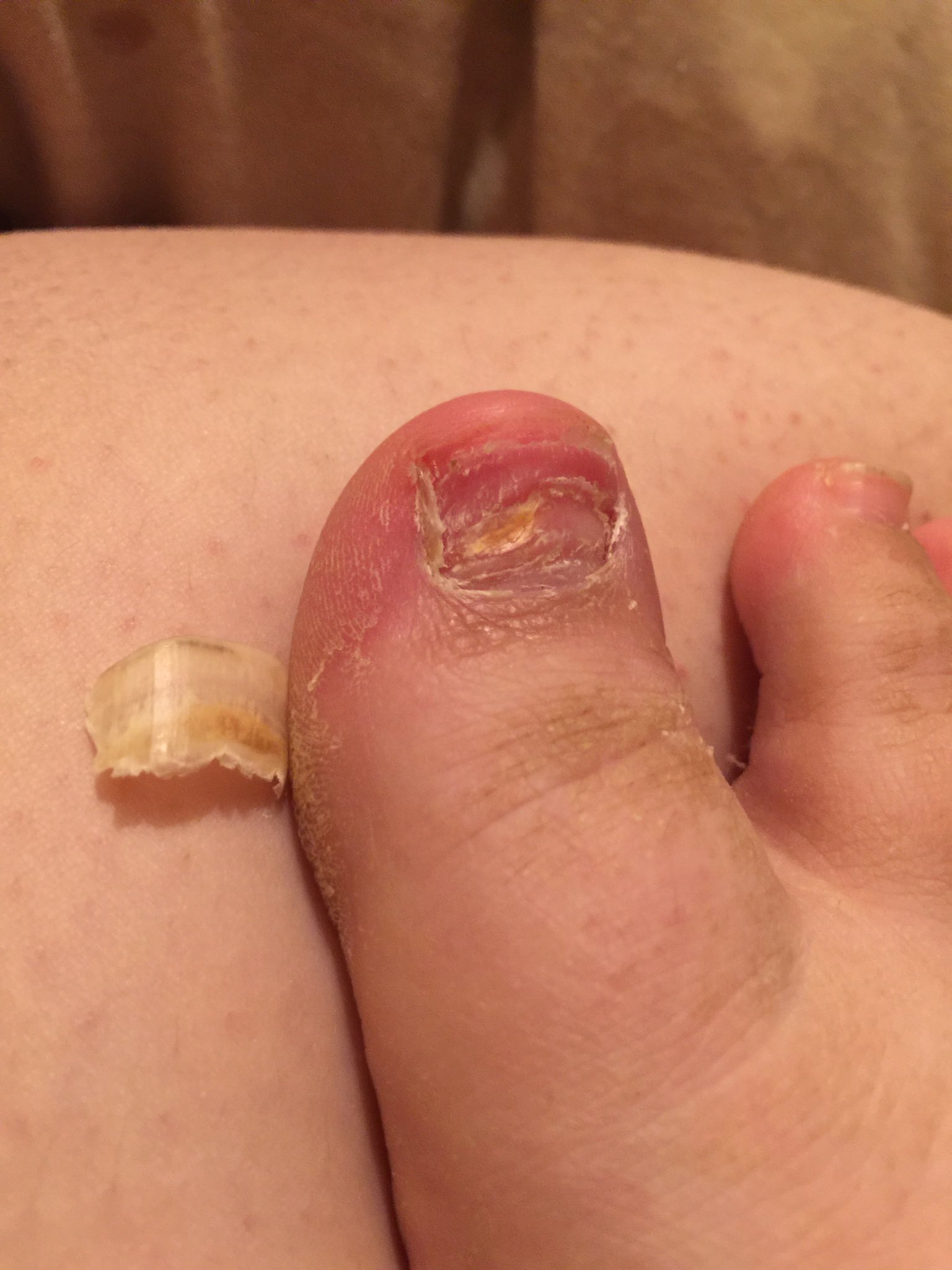 How To Remove Fake Dual Form Toenails ( Updated Version ) = GROSS - YouTube