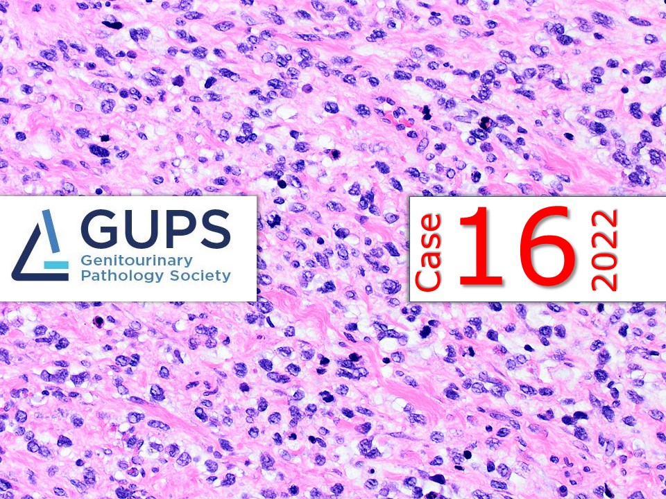 GU Pathology Society (GUPS) (@gu_path_society) on Twitter photo A male in his 20s, presented with a rapidly enlarging painless right scrotal mass.
Contributors: Crystal (Yitong) Xu, <a href="/Kiril_T_Can/">Kiril_T_Can</a>
The <a href="/GU_Path_Society/">GU Pathology Society (GUPS)</a> Case of the Week: gupathsociety.org/COW-2022-16
Send your cases to @akgulMD
#GUPSCOW #GUpath #pathology A male in his 20s, presented with a rapidly enlarging painless right scrotal mass.
Contributors: Crystal (Yitong) Xu, <a href="/Kiril_T_Can/">Kiril_T_Can</a>
The <a href="/GU_Path_Society/">GU Pathology Society (GUPS)</a> Case of the Week: gupathsociety.org/COW-2022-16
Send your cases to @akgulMD
#GUPSCOW #GUpath #pathology