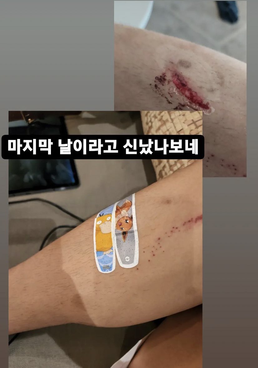 taeteland's tweet photo. omg no taehyung got hurt poor baby :( https://t.co/eLDlHKugxk