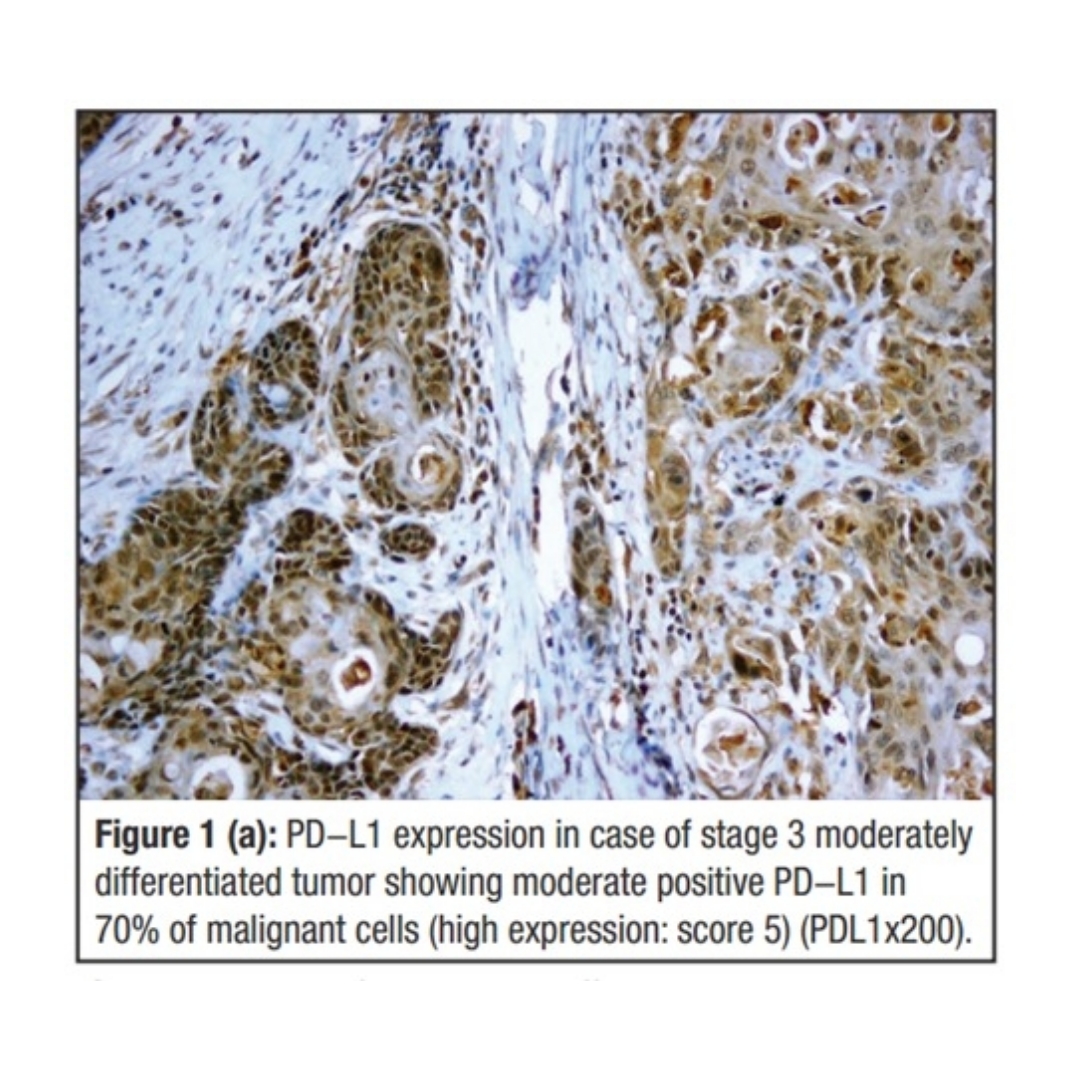 JournalGulf's tweet photo. #issue37
Correlation Between Tumor Infiltration CD8+ T-cells And PD-L1 Expression In Laryngeal Cancer And Their Prognostic Significance: Prospective Non-interventional Trial
https://t.co/LCtrfJxwTY
#GJO #kuwait #gulf #oncology #pubmed #cancer #manuscripts #articles https://t.co/bgcifQUyNm