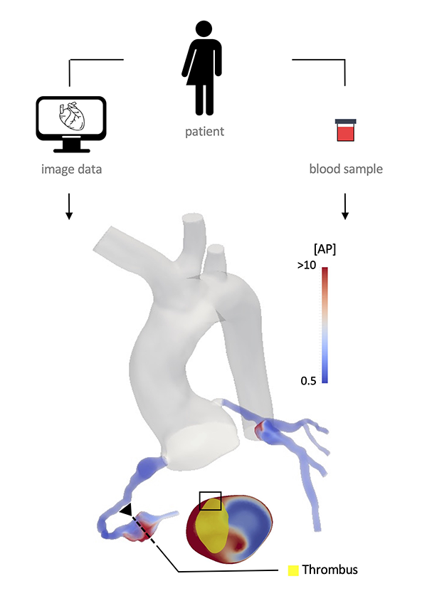 CMU Mechanical Engineering (@cmumeche) on Twitter photo The Biomedical Flows Simulation & Multiscale Modeling (BioSiMM) Lab will enable personalized medical therapies for thrombosis, cardiovascular disease, and more: bit.ly/3vpYmwf <a href="/ngrandeg/">Noelia Grande Gutiérrez</a> #biomedical #fluiddynamics The Biomedical Flows Simulation & Multiscale Modeling (BioSiMM) Lab will enable personalized medical therapies for thrombosis, cardiovascular disease, and more: bit.ly/3vpYmwf <a href="/ngrandeg/">Noelia Grande Gutiérrez</a> #biomedical #fluiddynamics