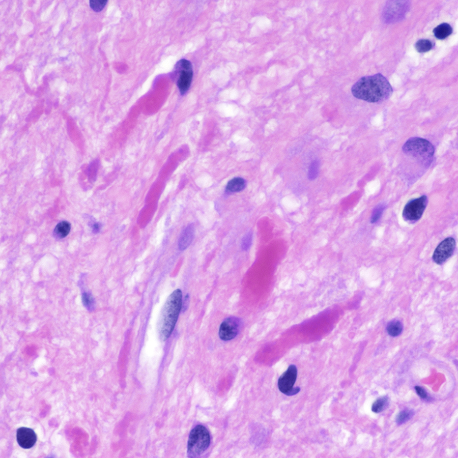 CraigHorbinski's tweet photo. Cerebellar tumor in a child. Diagnosis? You really only need one image, but I'm a sweetheart, so I gave you two. 😇 #pathology #neuropath #PathTwitter #pedipath https://t.co/CUtS9z5PKc