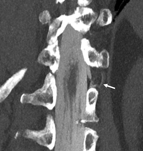 Photon-counting CT visualizes cerebrospinal fluid (CSF) venous fistula (CVF) better than traditional imaging approaches such as CT myelography or MRI, according to a report in @JAMANeuro led by Dr. Fides Schwartz of @DukeRadiology. #radiology bit.ly/3MirxZb