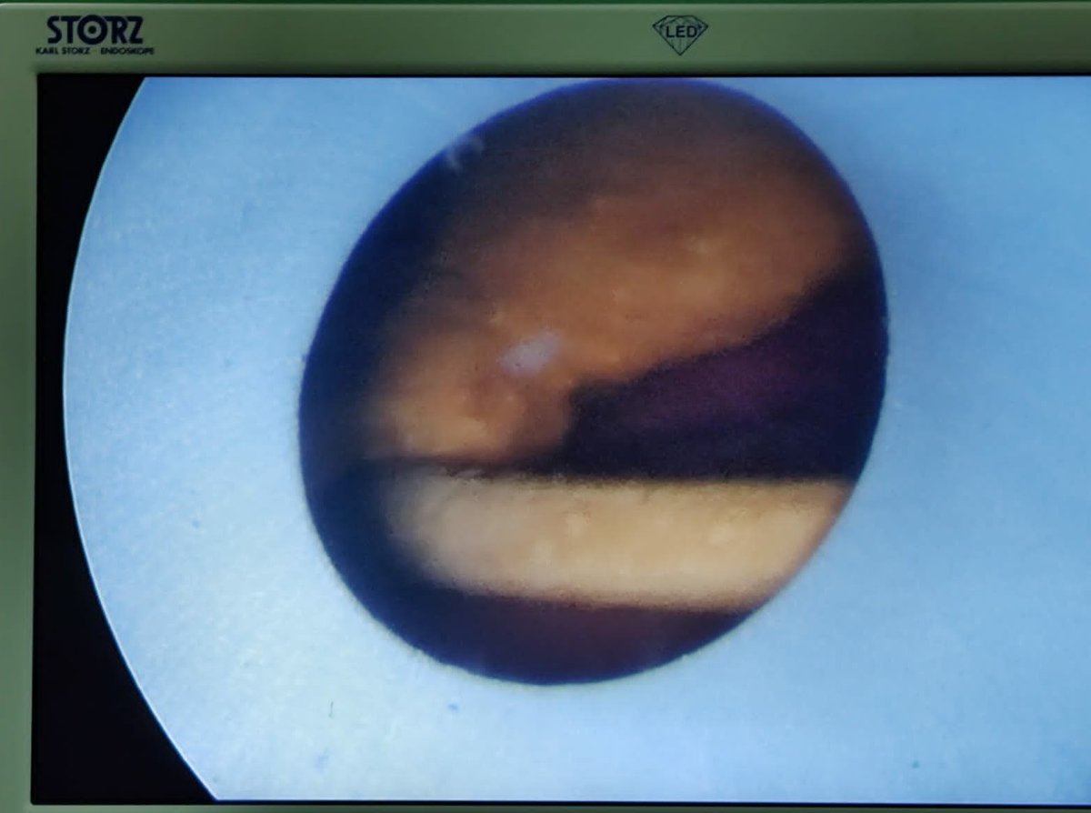 EmaMarPa's tweet photo. Woman🚺. 30 years.♀️
➡️Encrusted ureteral stent distal calcification. #FECal III (inverted) and #VGUES Type Ac.
✅Completely removed by cystolithotripsy with 24 Fr AMPLATZ SHEAT through the urethra.
📌Q: it safe or risky for the female urethra?🤔 @Endo_Society @JEndourology https://t.co/xdiK4Kt6st
