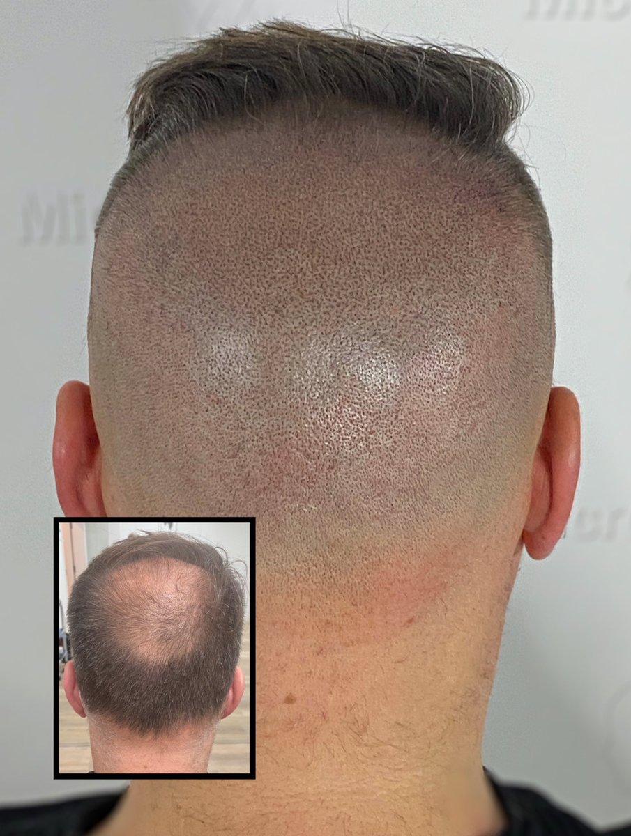 microcapillaire's tweet photo. Bye bye baldness #microcapillaire 

💻https://t.co/9AfpB4Rf3C https://t.co/cmYpx5nB2j