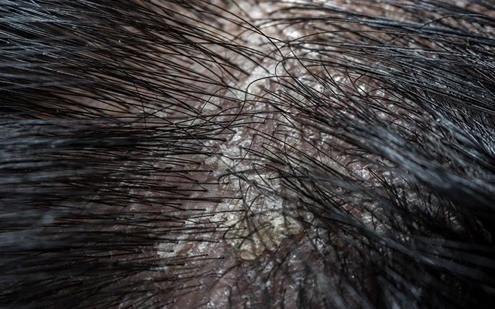 nunnajmeen's tweet photo. Perasan tak after 2-3 hari tak shampoo, akan ada this tiny white flakes yg macam daki ni?

That’s most probably PRODUCT BUILDUP on the scalp https://t.co/FMPrvViwUV