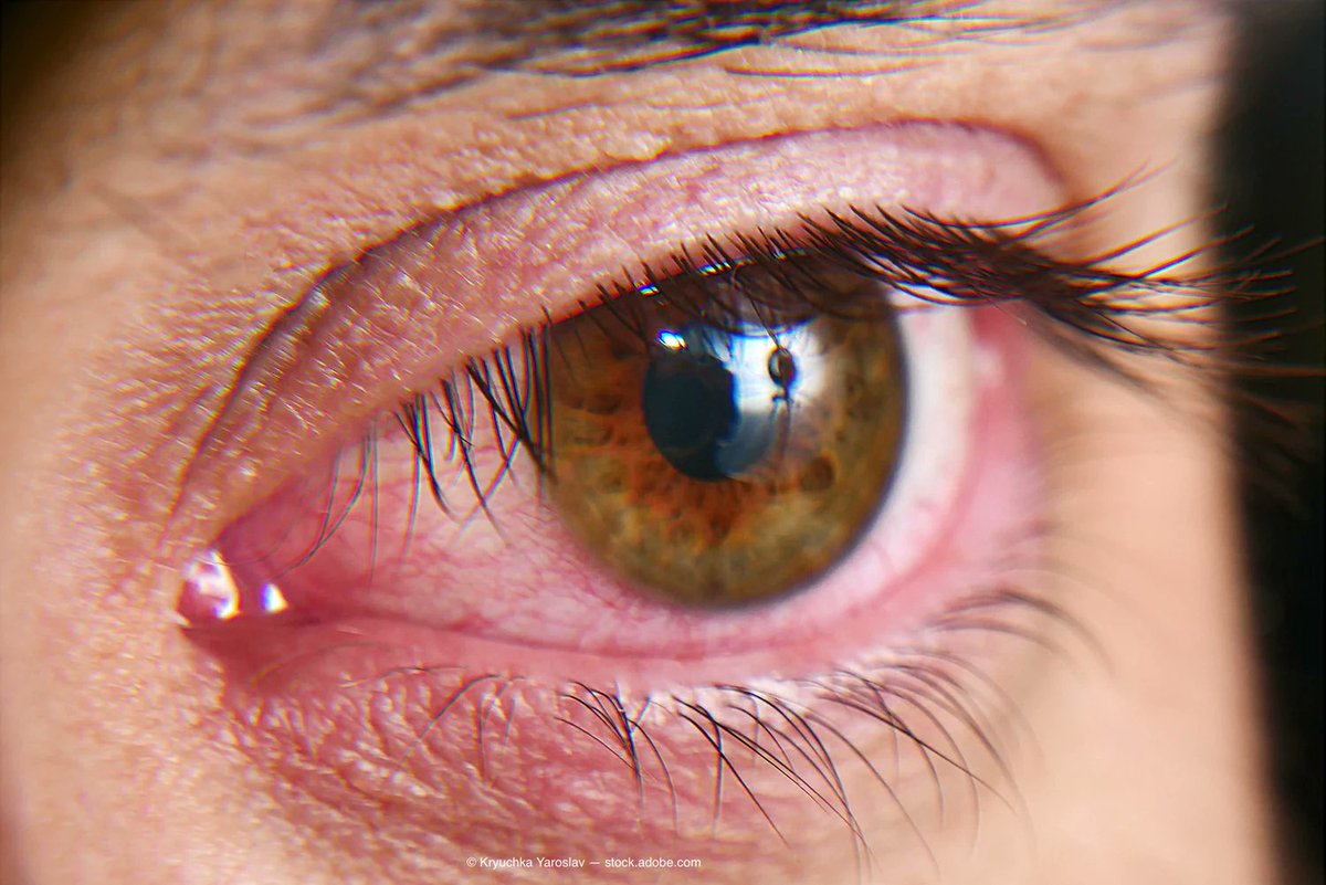 Ophthalmologyd8's tweet photo. Aldeyra Therapeutics completes enrollment in Phase 3 TRANQUILITY-2 trial
Visit: https://t.co/MRE3gH4I2c
Global Ophthalmology 2022
May 04-05 2022 Prague, Czech Republic
#PoydxZeeNuNew https://t.co/7tD3ohotlm