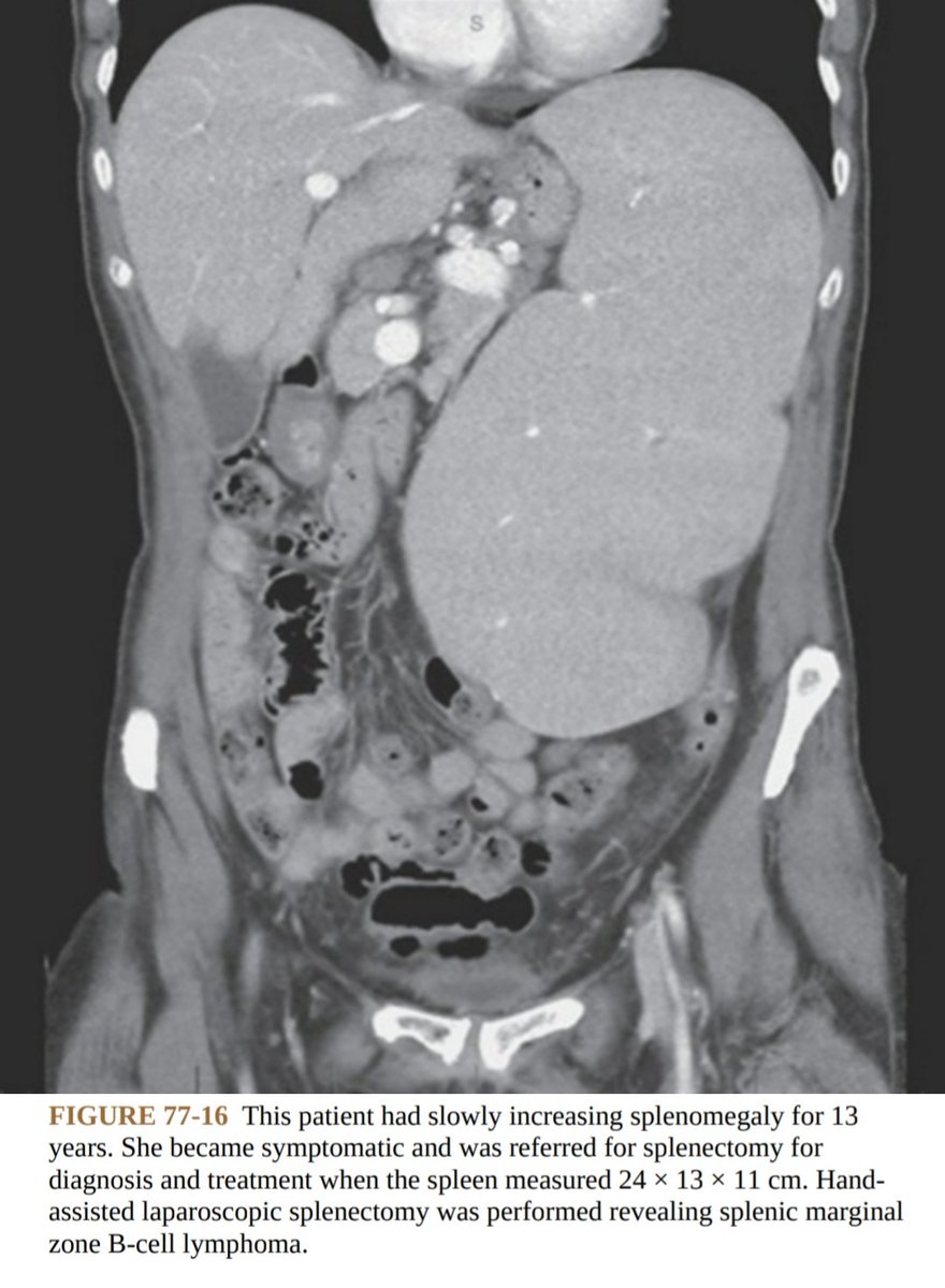 DRAFTABAHMED7's tweet image. 🅐︎ Classification of splenomegaly based on CT or post-resection weight 🅑︎ Patient Selection for Laparoscopic,Hand-Assisted
Laparoscopic,or Open Approach 🅒︎Preoperative Splenic Artery Embolization
𝗥𝗲𝗳:Maingots abdominal surgery 
#splenomegaly #MedTwitter 
#splenectomy