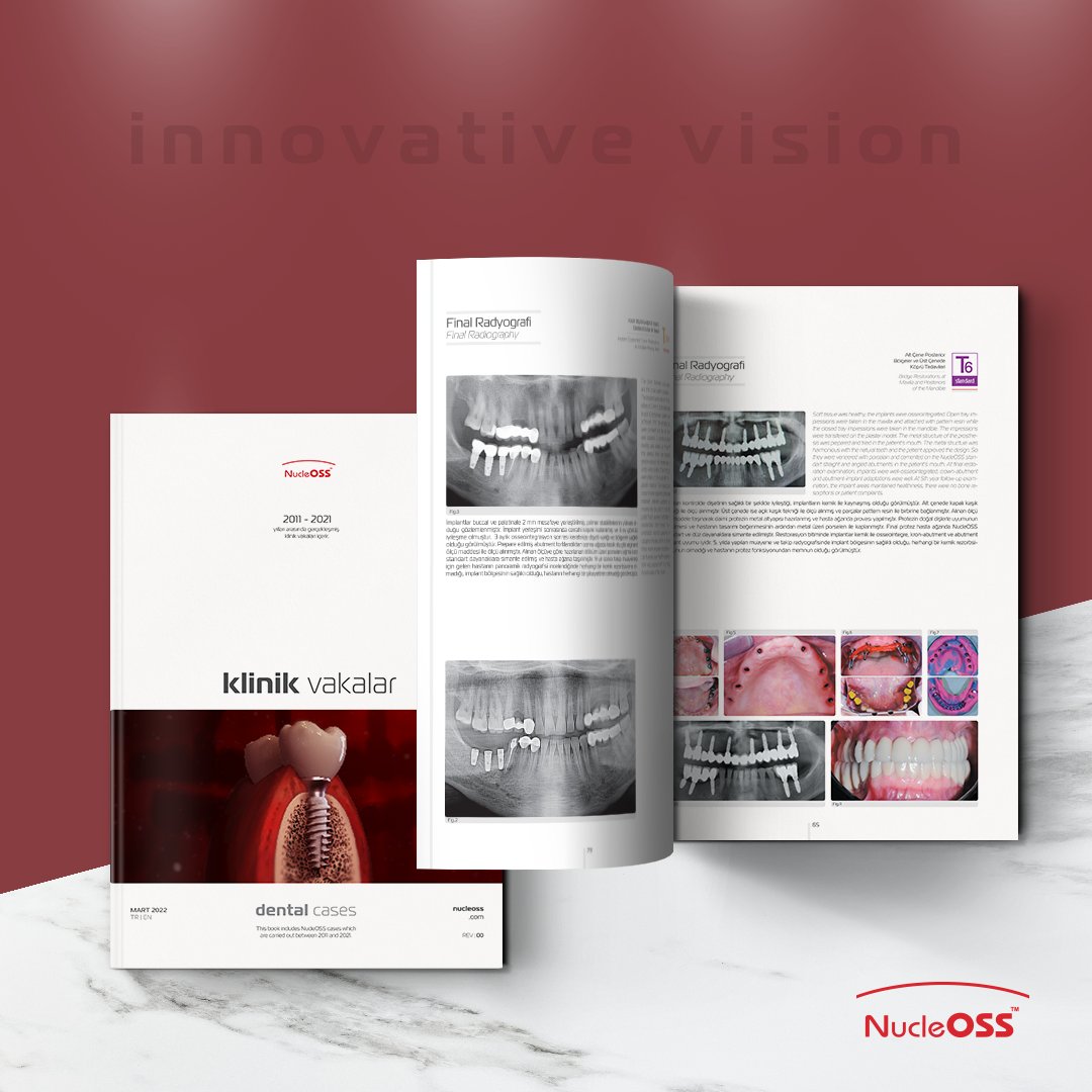 NucleOSS's tweet photo. Klinik vakalar kitabı NucleOSS implantlarını kullanan diş hekimlerimizin vakalarından derlenmiştir. Hekimlerimize katkılarından dolayı teşekkür ediyoruz.

NucleOSS - innovative vision

#T6standard #klinikvaka #dentist #implantology  #dentalimplant #nucleoss #innovativevision https://t.co/Fw8BXlqw3V
