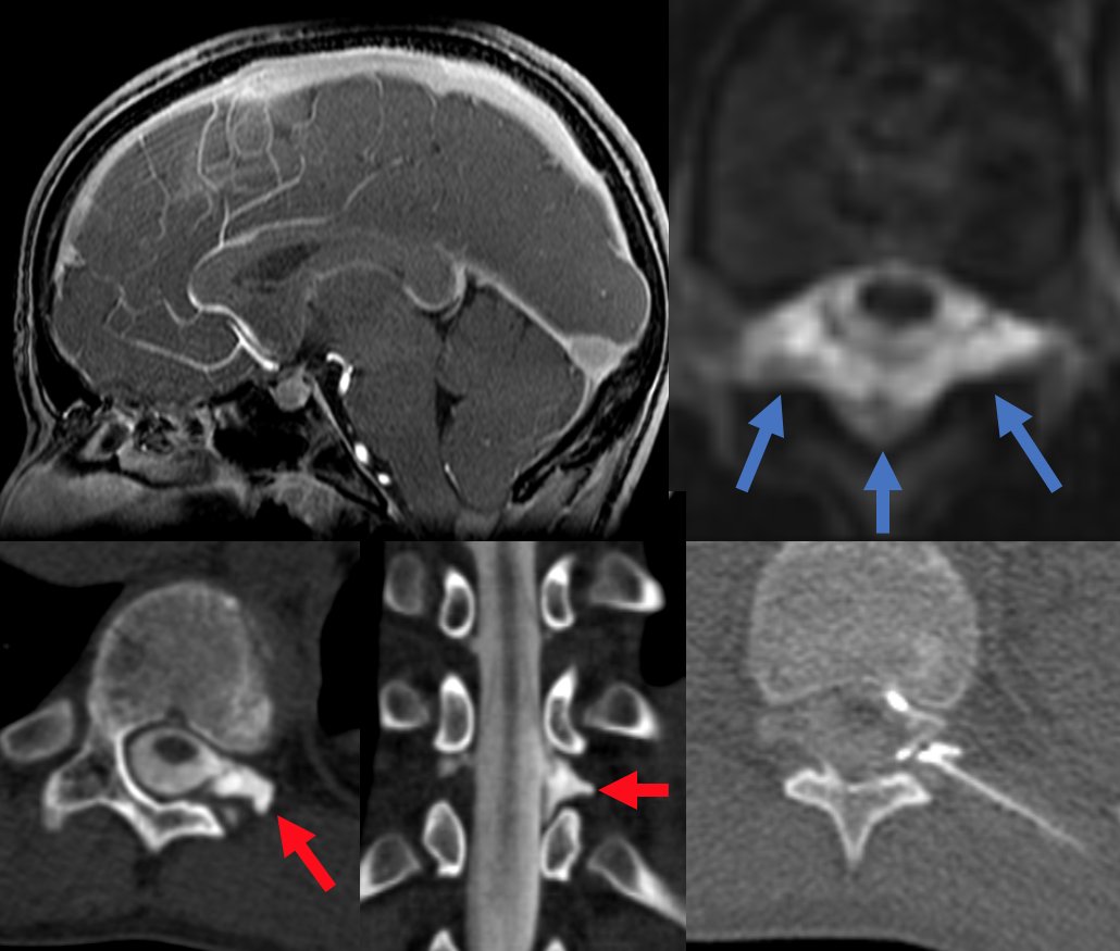 An important #SIH paradigm: the leaking patient with a dorsal epidural collection without ventral component. This young patient with no ventral osteophytes or ventral collection was found to have a fast lateral leaking cyst on decubitus dynamic myelography, treated with fibrin.