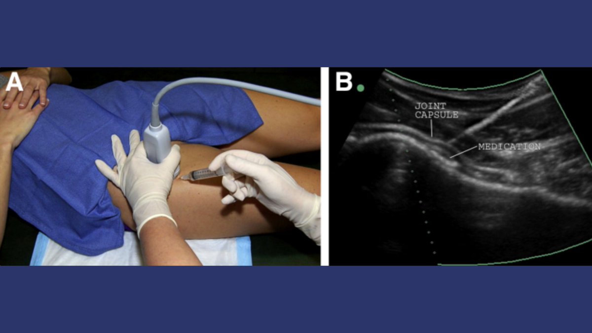 nashvilleorthos's tweet photo. Ultrasound-guided intra-articular injection has become a mainstay in the diagnosis and treatment of a variety of #hipdisorders. Check out this study co-authored by Dr. Byrd and Beth Bardowski. https://t.co/g9gcWXfgsH #hipinjection https://t.co/m23HNovuy1