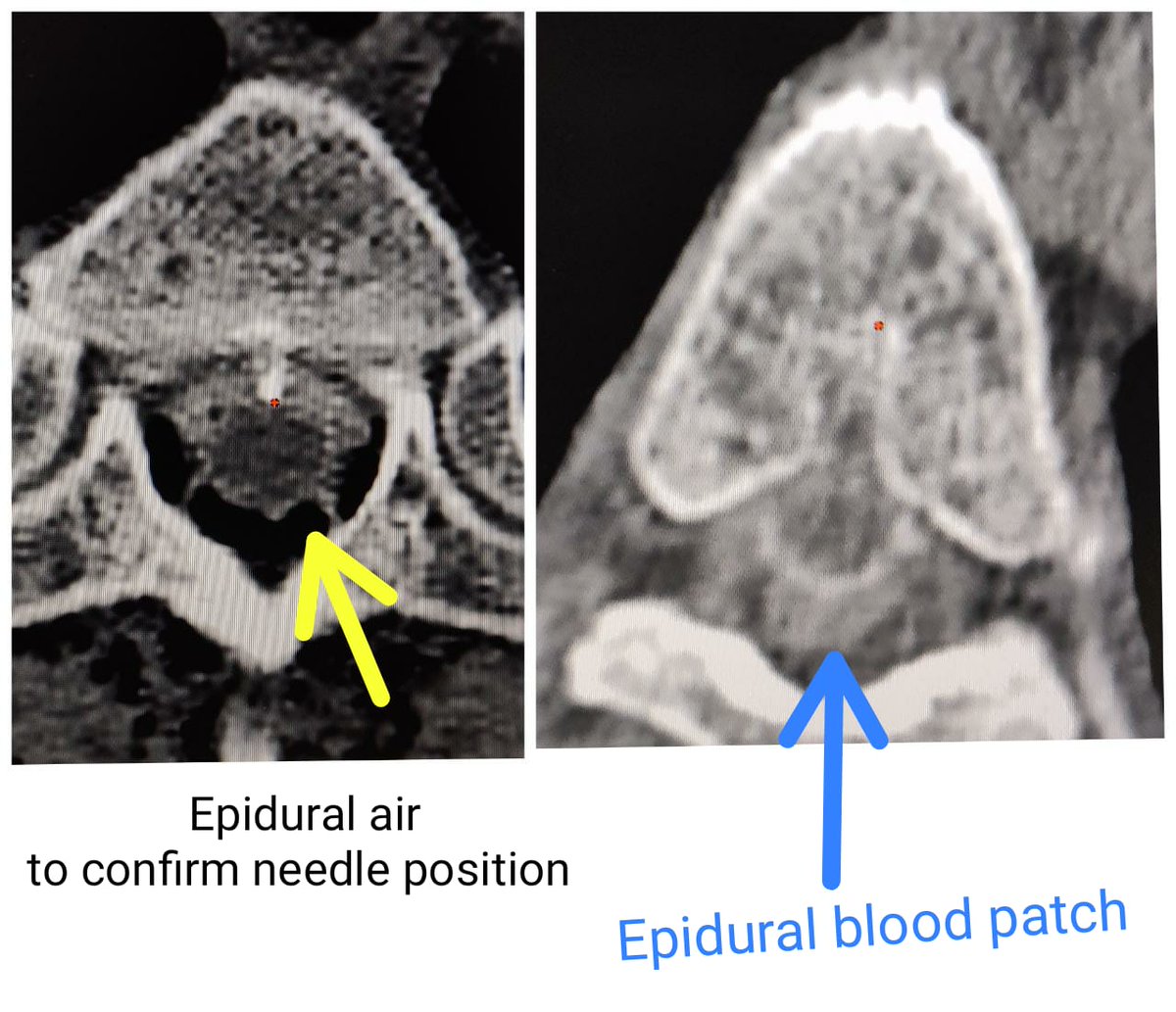 SharathKumarGG7's tweet photo. Helping another Spinal CSF leak patient with 🎯 epidural blood patch. This is our 5th patient in our last few days! All due to type 1 ventral leak by the bony spicule and all are stable without recurrence #MedTwitter #neurotwitter #spinalcsfleak #headache #Epiduralbloodpatch https://t.co/AugbnUEMiA