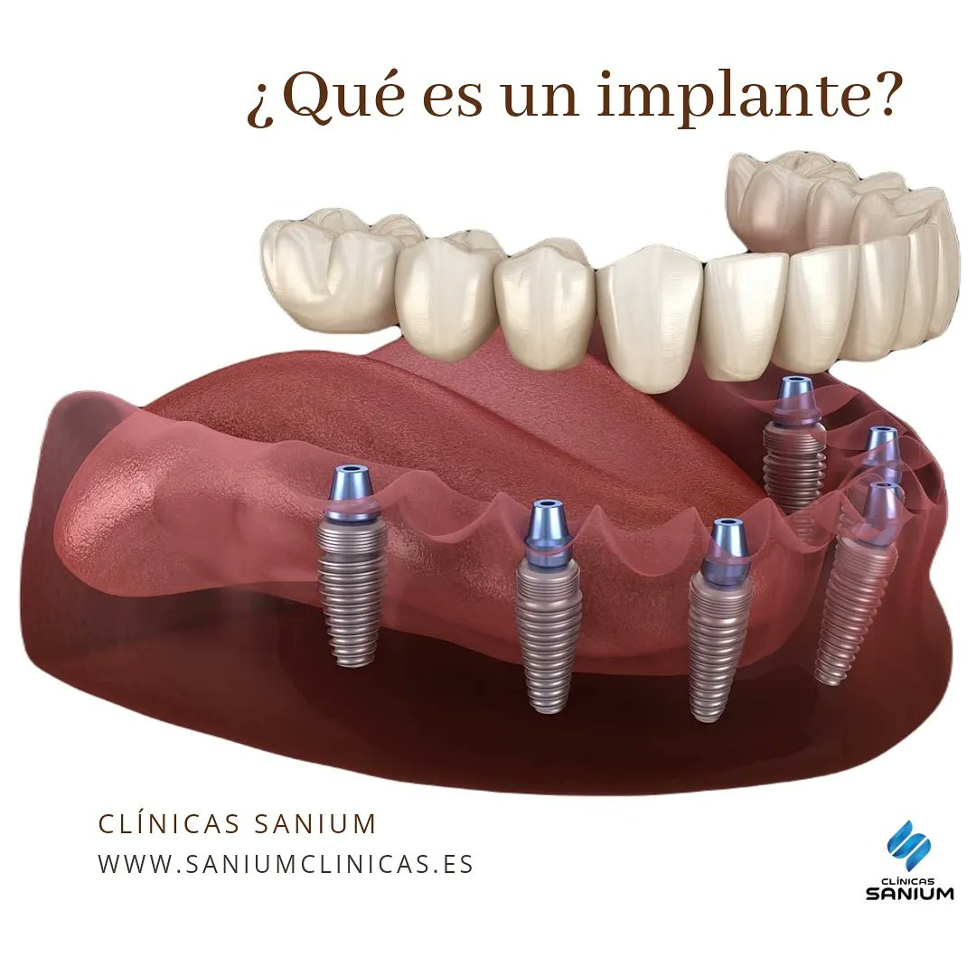 clinicassanium's tweet photo. Los implantes son dientes artificiales. Tanto en su forma como en su función y su estética. Son el tipo de prótesis que mejor reproduce los dientes naturales. ⁣
⁣
Cada implante tiene 2 partes:⁣
👆 𝐋𝐚 𝐫𝐚𝐢́𝐳
✌️ 𝐂𝐨𝐫𝐨𝐧𝐚

Ponte en contacto con nosotros y te ayudaremos. https://t.co/1syHZn91M7