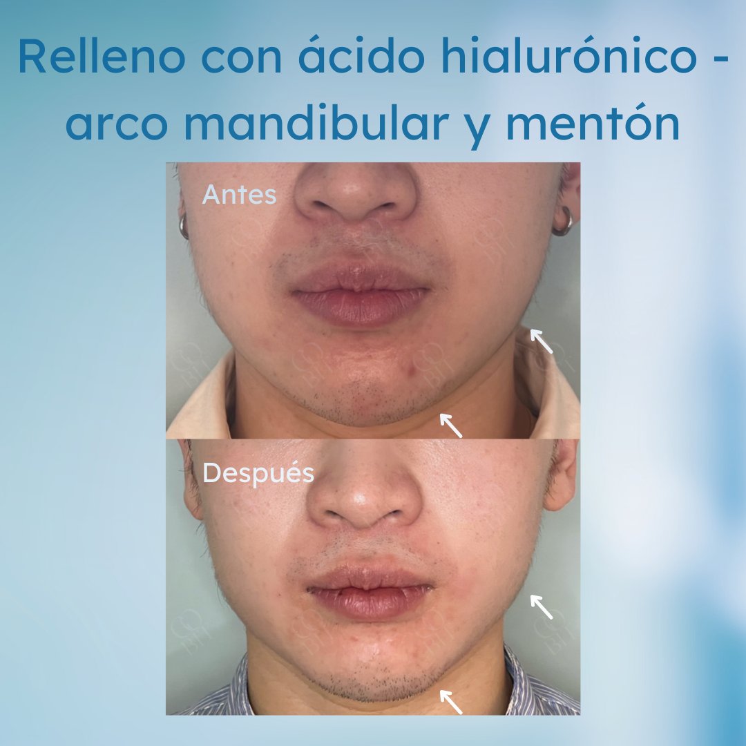 GoBIT_clinic's tweet photo. En Gobit, podemos masculinizar la forma de mandíbula con ácido hialurónico, y obtener un perfil más maduro.

Consulta con nuestros especialistas. 

#GoBIT #GoBackInTime #belleza #beauty #salud #estetica #mujer #skincare #bienestar #piel #cabello #mujeres #beautiful #natural https://t.co/HZGnlopXQU