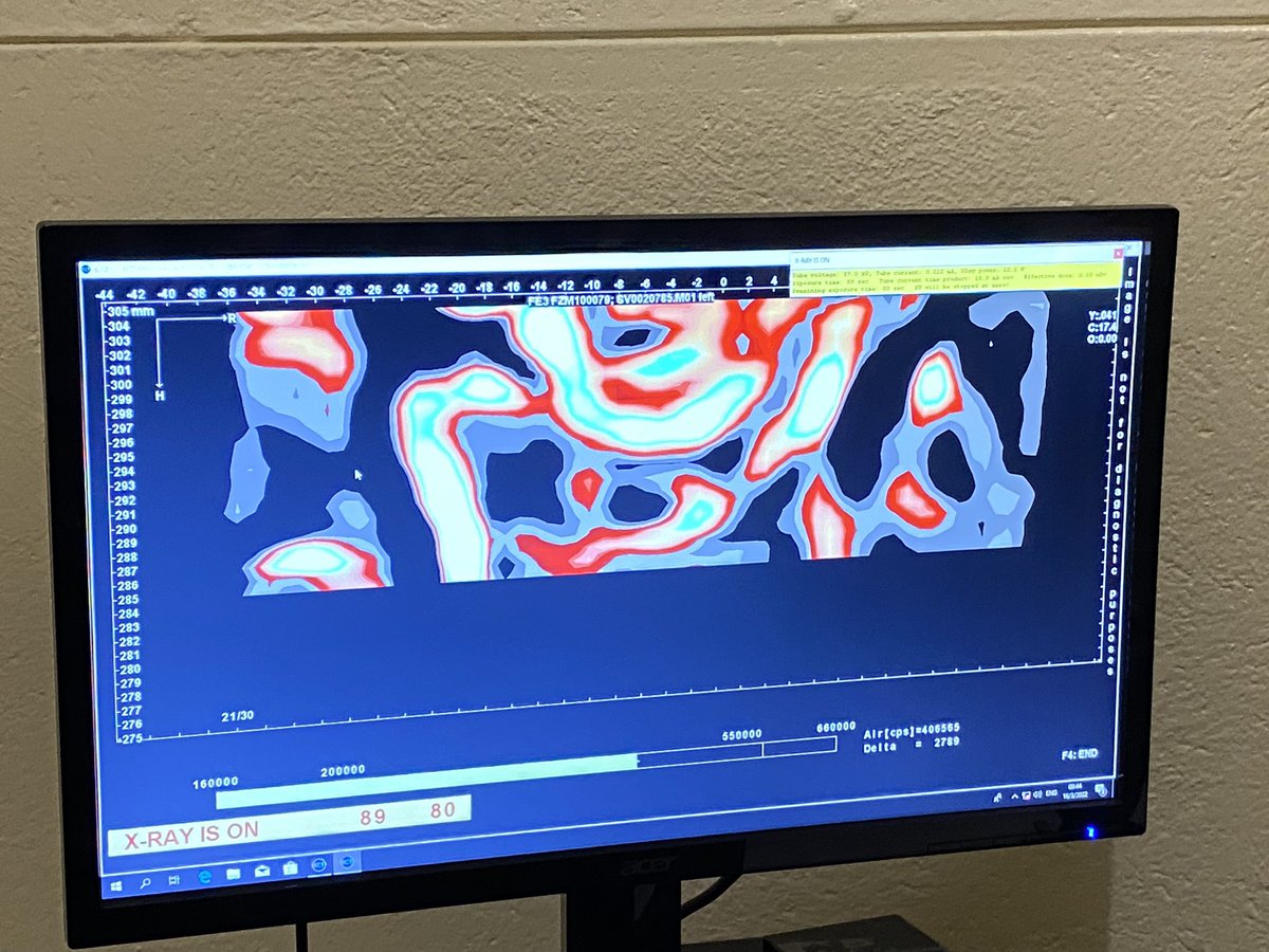 Rashida Abbas Ferrand (@rashida_abbferr) on Twitter photo <a href="/cynkahari/">Cynthia Kahari, PhD</a> trying to explain to me these lower limb pQCT data she is capturing as part of her PhD investigating bone architecture in various bone diseases in Zimbabwe (don’t totally get it.. but best part of job is working with people so much smarter than me)😊 <a href="/cynkahari/">Cynthia Kahari, PhD</a> trying to explain to me these lower limb pQCT data she is capturing as part of her PhD investigating bone architecture in various bone diseases in Zimbabwe (don’t totally get it.. but best part of job is working with people so much smarter than me)😊