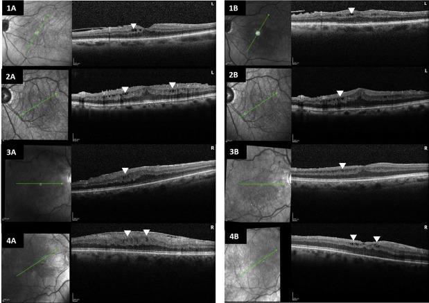 Ophthalmology (@aaojournal) on Twitter photo Multivariate analysis of ERM surgery on eyes w/ #glaucoma from <a href="/Wills_Eye/">Wills Eye Hospital</a> shows advanced cupping assc w/ poor visual outcomes. Inner retinal microcystoid changes assc. w/ worse vision at all time points but does not limit visual gains ow.ly/KG3T50IvCm0 Multivariate analysis of ERM surgery on eyes w/ #glaucoma from <a href="/Wills_Eye/">Wills Eye Hospital</a> shows advanced cupping assc w/ poor visual outcomes. Inner retinal microcystoid changes assc. w/ worse vision at all time points but does not limit visual gains ow.ly/KG3T50IvCm0