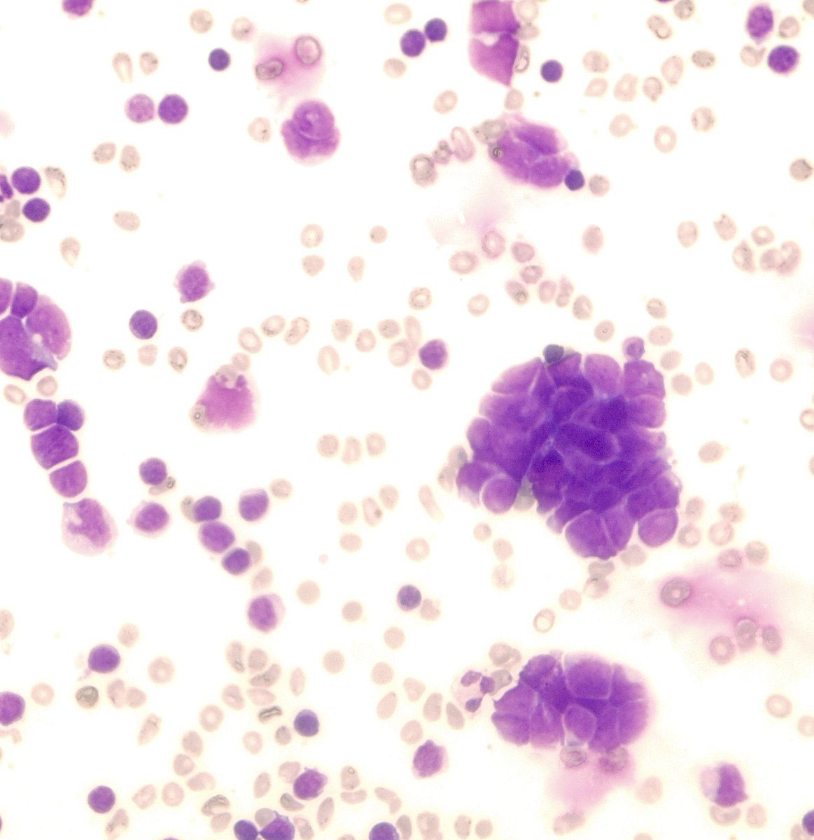 SamKhader's tweet photo. Only a small minority of patients with small cell carcinoma of the lung develops metastatic pleural effusion. Two images from a Diff-Quik stained cytospin preparation showing mostly clustered malignant cells with molding, scant cytoplasm, and fine chromatin. #CytoPath #Pathology https://t.co/4mjy4EEIHa
