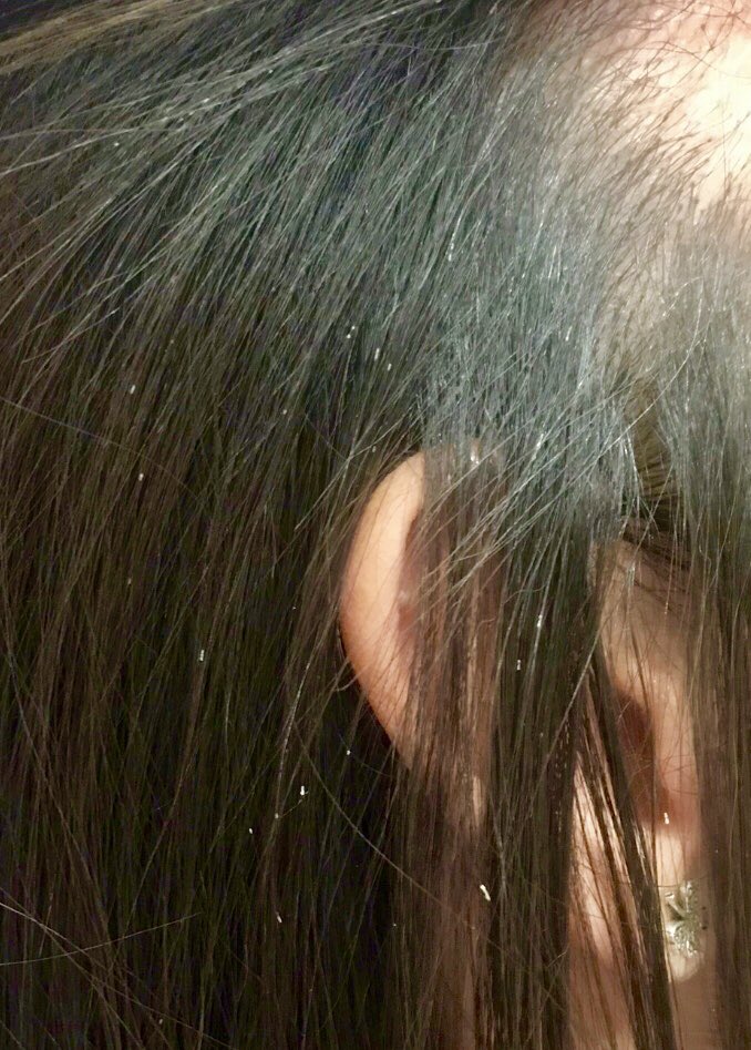 julianconejomir's tweet photo. Vainas peripilares. Habituales en chicas jóvenes que se peinan muy tirante el pelo. @DermaHUVRocio https://t.co/MSySfsMz9X