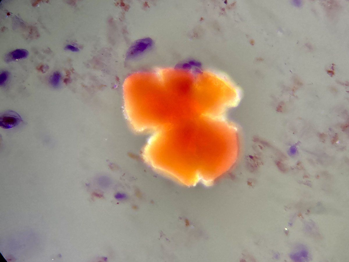 At glance, ciprofloxacin crystals might be confused with muddy brown granular casts #UrinarySediment #UrineMicroscopy
