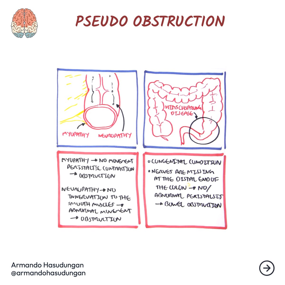 armandohasudung's tweet image. A bowel obstruction is a severe condition that occurs when something blocks your intestines, either large or small intestines.

Full Video
buff.ly/37pkDmc

Detailed Post
buff.ly/34r1Hle

#bowelobstruction #intestinalobstruction #smallintestines #largeintestines