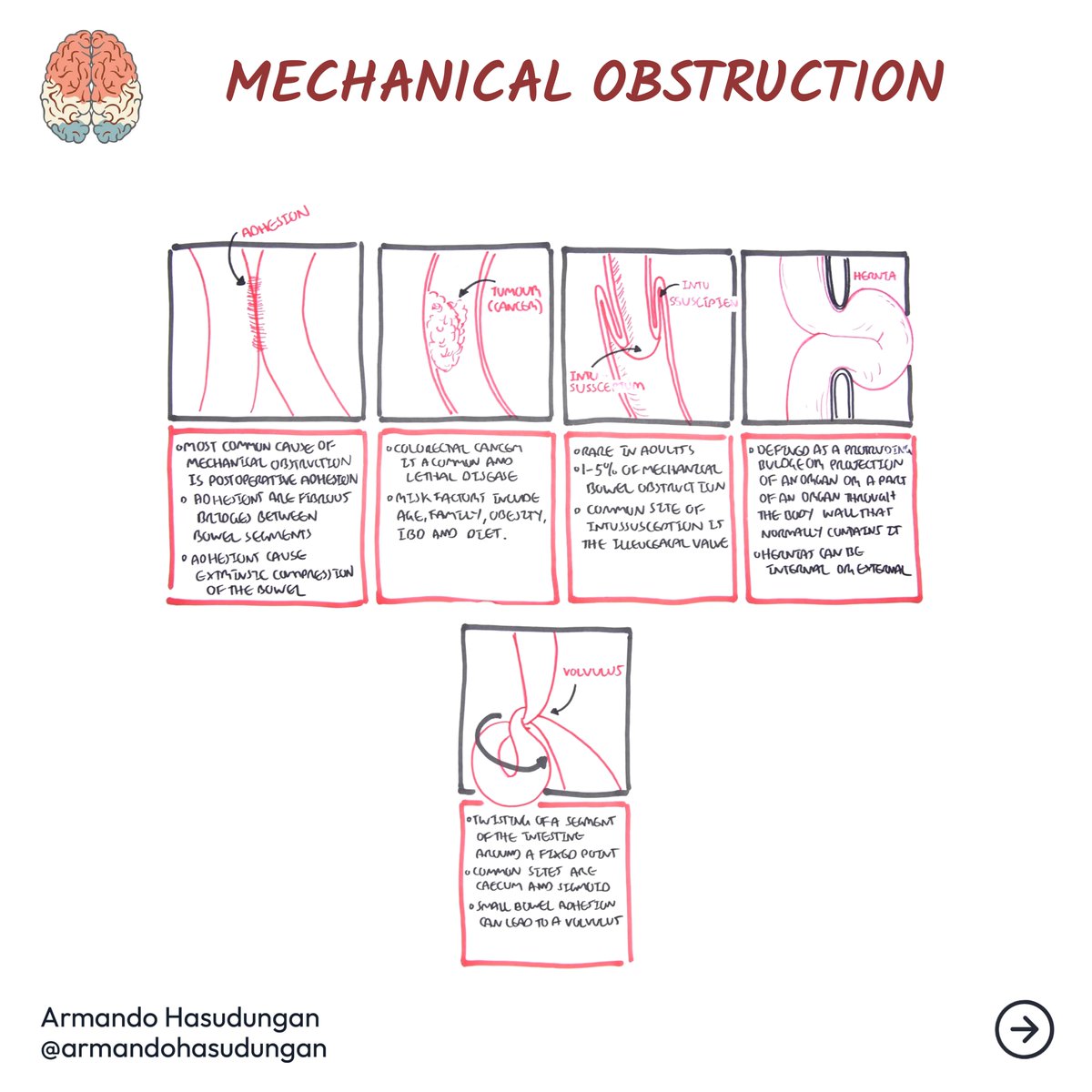 armandohasudung's tweet image. A bowel obstruction is a severe condition that occurs when something blocks your intestines, either large or small intestines.

Full Video
buff.ly/37pkDmc

Detailed Post
buff.ly/34r1Hle

#bowelobstruction #intestinalobstruction #smallintestines #largeintestines