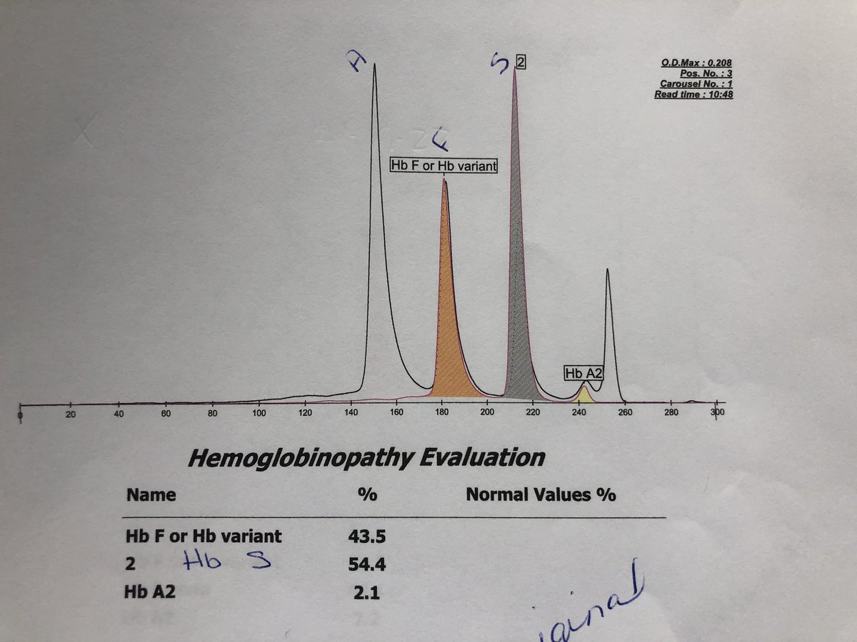 jayati_mallick's tweet photo. Another one, compound heterozygous HbS and HPFH. https://t.co/NWORwKXaVp