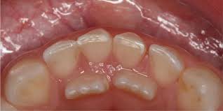 يستخدم مصطلح أسنان القرش لوصف الحالة التي تظهر فيها الأسنان الدائمة خلف أسنان الطفل اللبنية قبل أن تسقط، مما يؤدي إلى ظهور صفين من الأسنان، ويحدث هذا عادة بين سن 5-7 سنوات.

لاداعي للقلق، غالبًا لا يتطلب اي علاج، لأن السن اللبني يصبح تدريجياً أكثر ارتخاءً ويسقط من تلقاء نفسه.