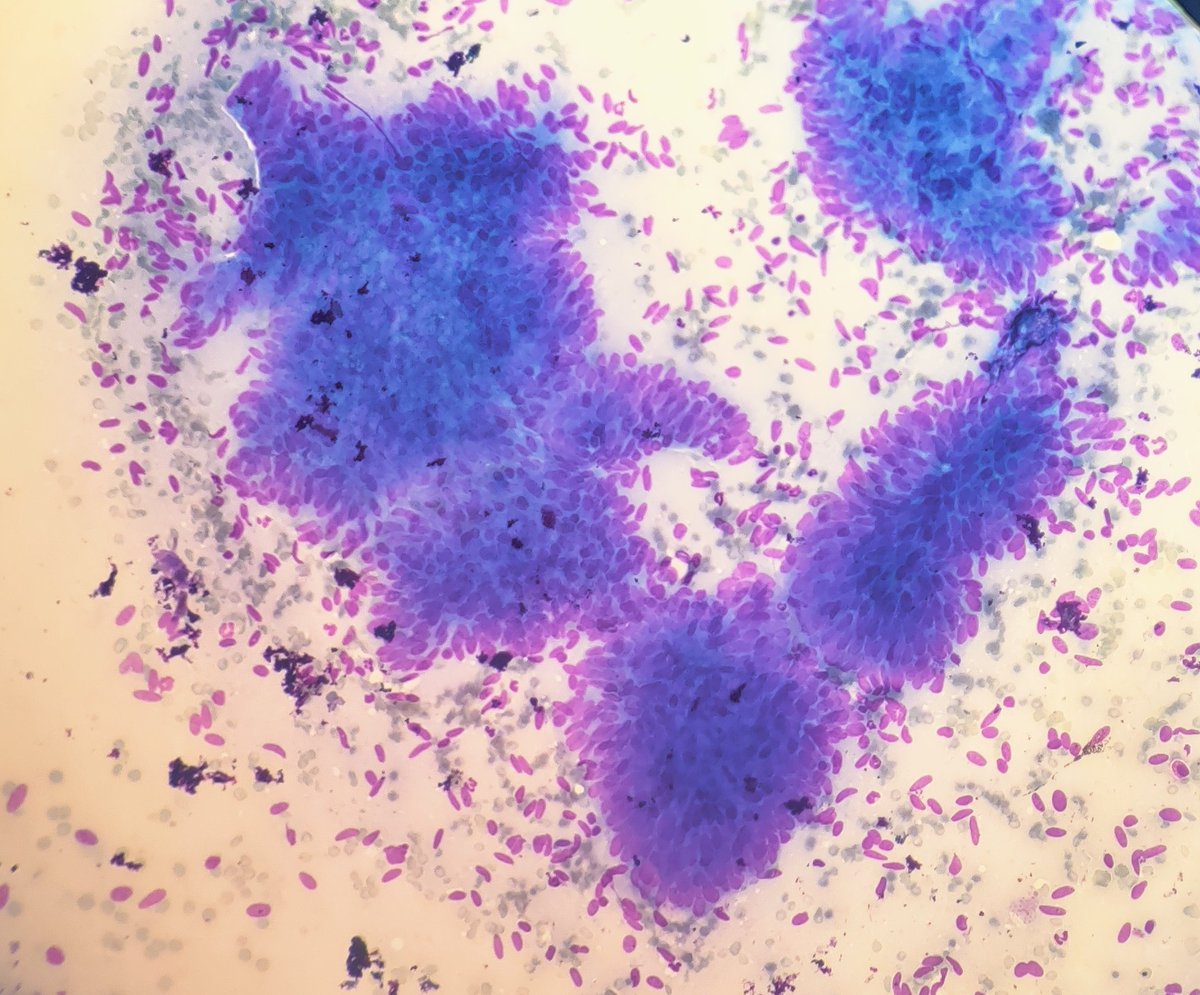 AnupamaArya12's tweet photo. 84/F perampullary mass #cytopath #pathtwitter #pancreas @pepeheffernan @vi_monappa @DrGeeONE @kriyer68 @ashokparameswar https://t.co/KKpYmsEWHf