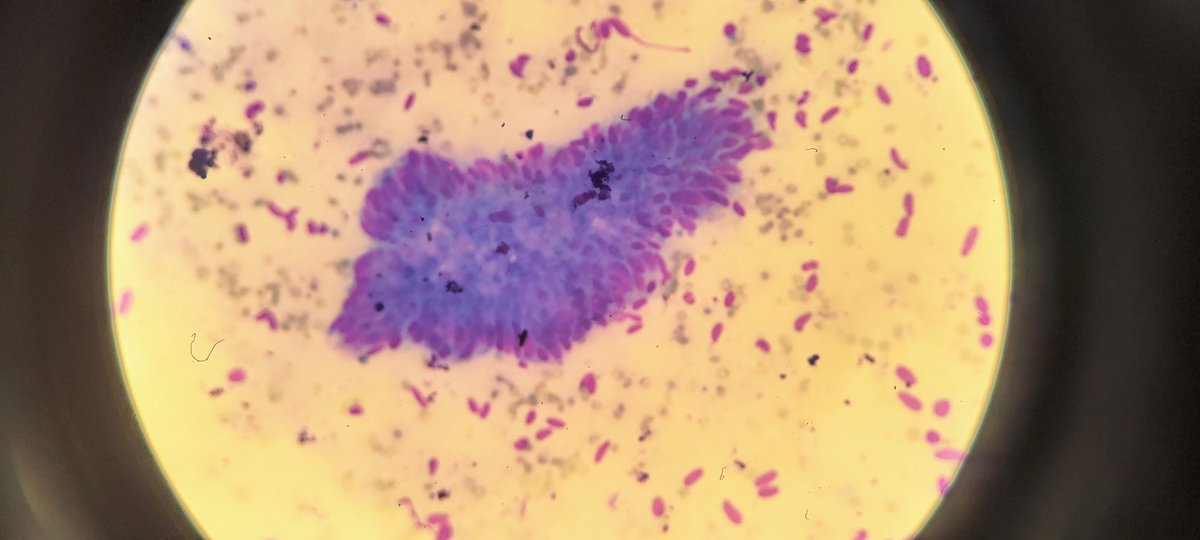 AnupamaArya12's tweet photo. 84/F perampullary mass #cytopath #pathtwitter #pancreas @pepeheffernan @vi_monappa @DrGeeONE @kriyer68 @ashokparameswar https://t.co/KKpYmsEWHf