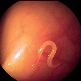 NematologyE's tweet photo. The pinworm, also known as #threadworm, is a parasitic worm. It is a #nematode and a common intestinal parasite or helminth, especially in #humans. https://t.co/v0SZm6CeCE