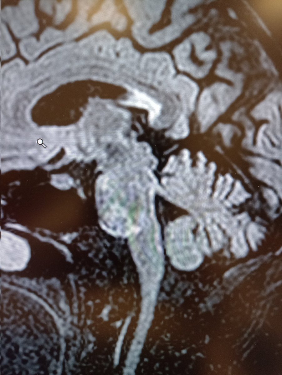 Brainstem  #Glioma treated with 2.7 Gy*15 Fr. and TMZ 75 mg/m2 in 73 y.o. male. Just 2 cycles of TMZ after RT/CHT ( suspended for low platelet count with a real difficult recover). Moderate hypofractionation seems a reasonable option also for these districts.#radonc