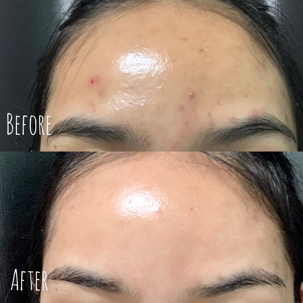 ป้ายยา! สกินแคร์ปราบสิวลูกรัก ใช้จริงไม่จกตา #Skinsista V clear Booster เริ่มจากใช้ซอง คือดีเกินเรื่องมากกก🥺 จนต้องตำขวด 💖 ชอบเนื้อบูสเตอร์อะ เข้มข้นแต่ซึมไว สิวผด สิวอักเสบคือหายไปเลย ยุบไวมาก ✨ เลิฟๆ ใครแพ้ง่ายแนะนำตำด่วน! #SSHonestReview #รีวิวปัญหาสิว