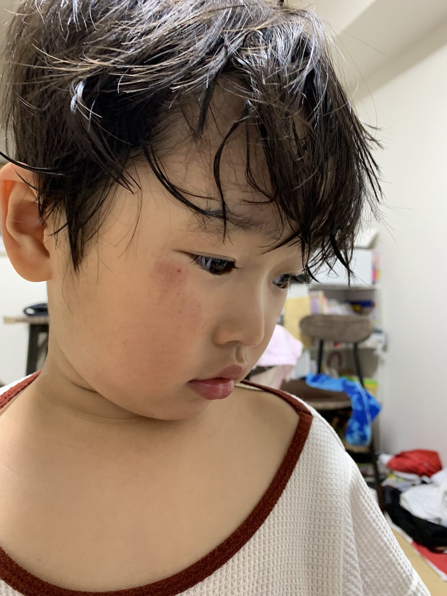 bobnick1915's tweet photo. 保育園からケガして帰ってきた‼️
男の子だね〜😌 https://t.co/n9own5CXK5