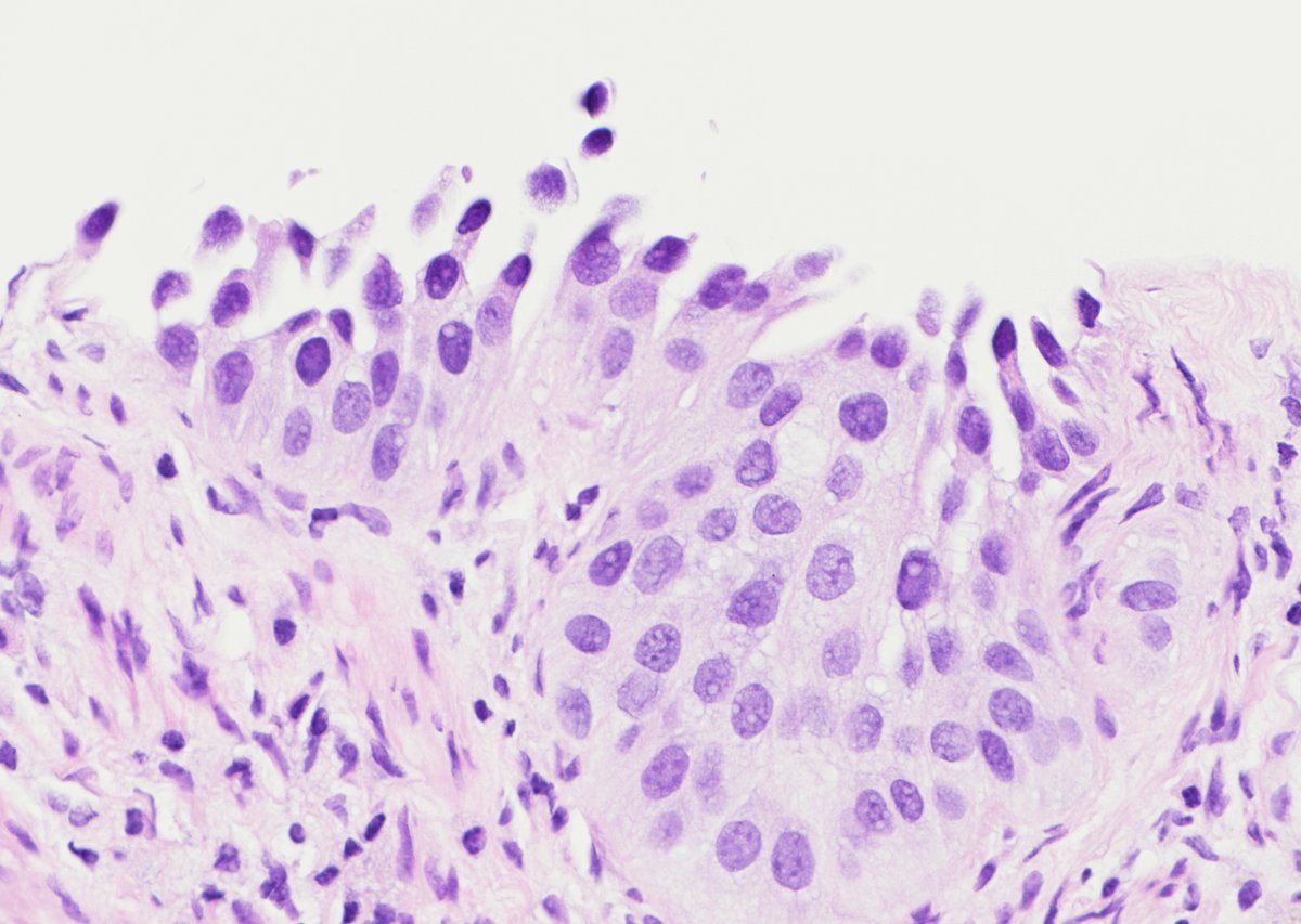 Abundant cercariform cells in a urothelial carcinoma – elongated cells with bulbous bodies and unipolar, cytoplasmic fluke-like tails can be a helpful clue to the diagnosis of transitional cell neoplasms (like in this case where the main ddx was renal versus urothelial origin).