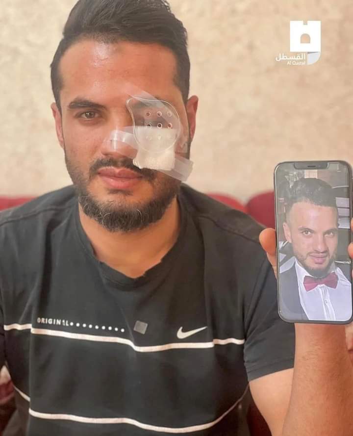 itxadilrazaq's tweet image. Palestinian young man before &amp;amp; after losing his eye by the israeli occupation forces in Al Aqsa mosque. #LeakedVideo