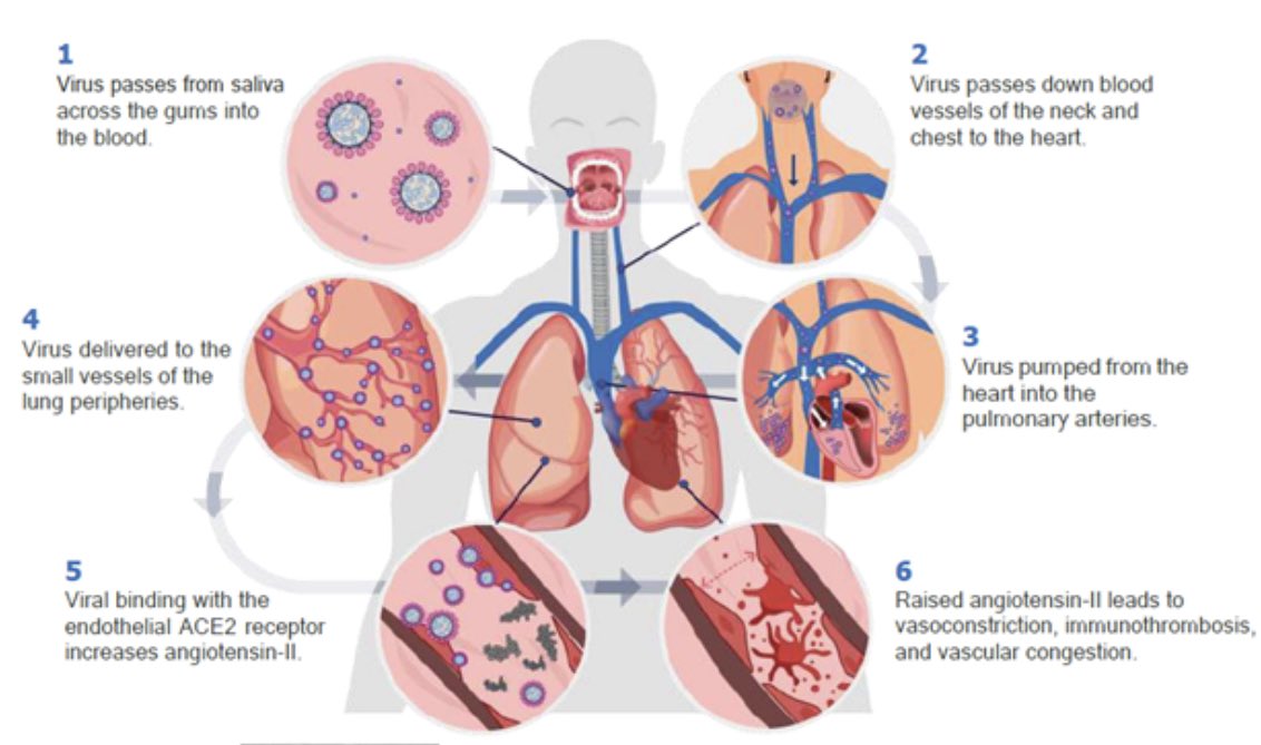 DrGrahamLJ's tweet photo. Published 1yr ago today -theory of vascular viral delivery from mouth to lungs.  #COVID-19 severity is determined by #oralhealth.
We now know specific mouthwashes inactivate #SARSCoV2 in vivo &amp; improve outcome. Here’s why.
https://t.co/chOncOzwWx
#mouthcarematters
@mcm_hekss https://t.co/K6DWHkea2F