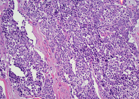 TexPathol's tweet photo. : Merkel cell carcinoma. Aggressive cutaneous neoplasm of neuroendocrine differentiation. Basaloid appearance of cells with high N:C ratio with granular to clear chromatin. Associated with Merkel cell polyomavirus. CK20 perinuclear dot-like+, neuroendocrine markers+. https://t.co/xdTSiFRoCi