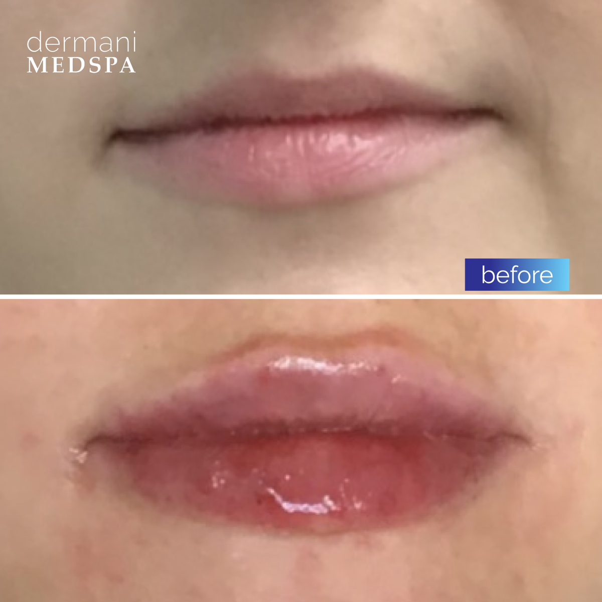 DOUBLE TAP if you're jealous of this client's #beautiful, #fulllips! 🤩

#Stunning, #plump lips can be yours with #JUVÉDERM Ultra XC! This client's results only took one syringe for just $399!

Visit dermanimedspa.com to book your FREE consultation today 💙