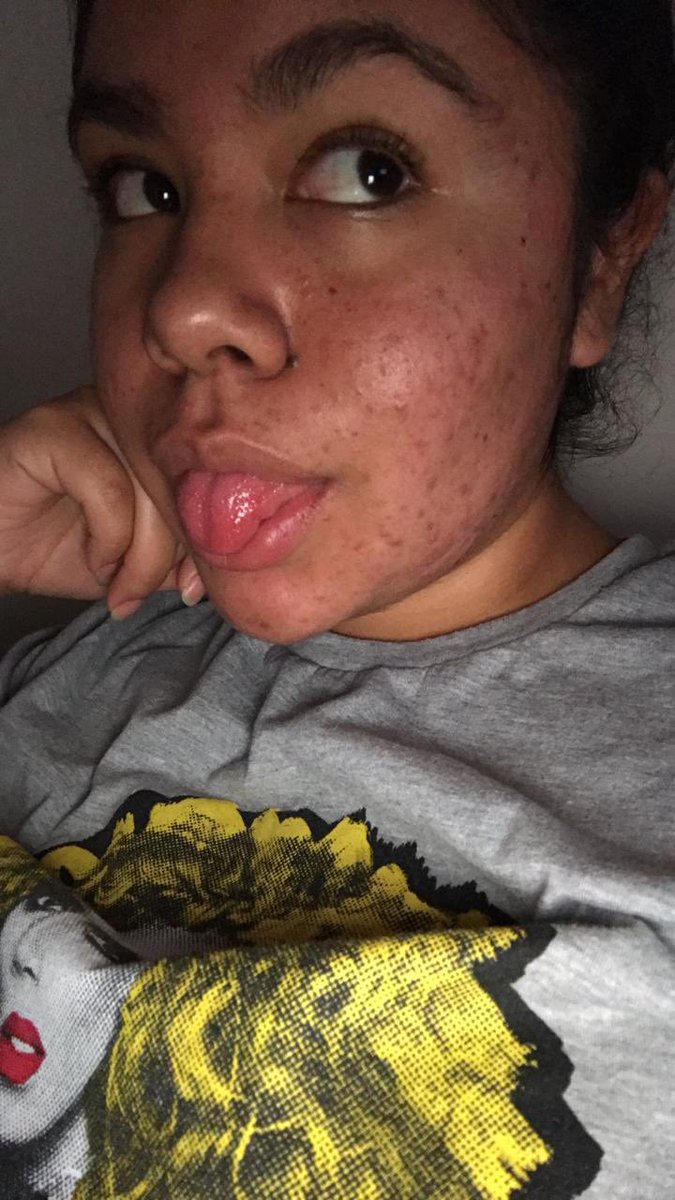 naoo_ls's tweet photo. solo quería contarle a todo el mundo queeee… solía tener una piel terrible y sufría mucho con ella, desde que empecé a hacer mi rutina de skincare y este año a tener un circuito de faciales, ahora hasta prefiero andar sin makeup🥳🥰 https://t.co/TET6e9bDk2