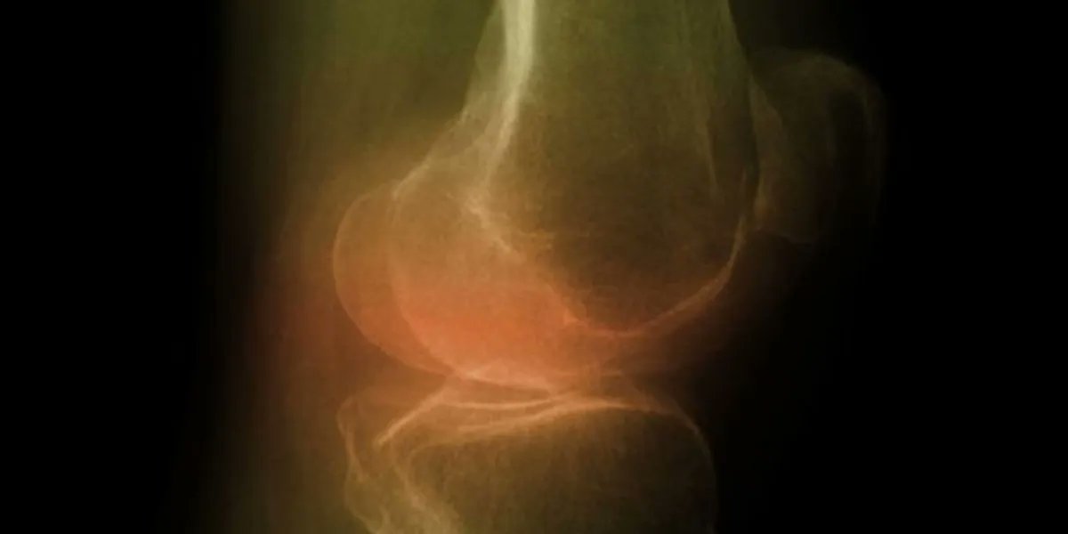 Knee Replacement in Folks Over 80: Less Risky Than You Think

The bottom line? "Age isn't the issue," he said. "It's all the other determining factors that go into it."

buff.ly/37tpiDw