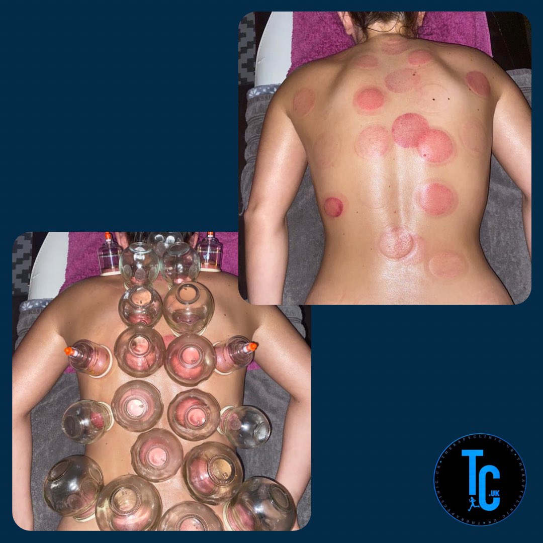 _gabybenbowx's tweet photo. https://t.co/2xjP32TSmv 💙

• Deep Tissue Massage 
• Cupping Therapy
• Sports Massage 

https://t.co/AMWIViquET https://t.co/csnsClKTZa