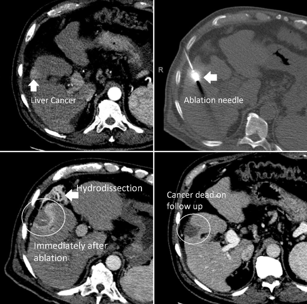 ajgunnmd's tweet photo. Small (sub 3cm) liver #cancer burned to death by interventional radiology (#IRad) using a single, thin needle placed through the skin under CT guidance. No scar, no hospital stay, and, more importantly, no cancer left on follow up imaging. https://t.co/BOdCRZn7nk