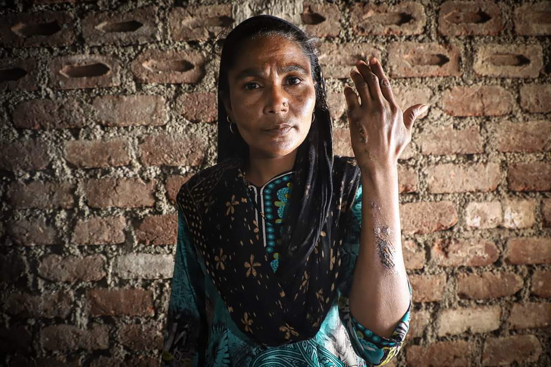 In Anand Nagar, Khargone, a Hindu mob in carrying swords attacked this old Muslim lady, Mehroon and tried to slash her face when the other lady, Zubeda tried to stop them they turned their swords against her too. They both ended up being physically hurt and ran away to Islampur