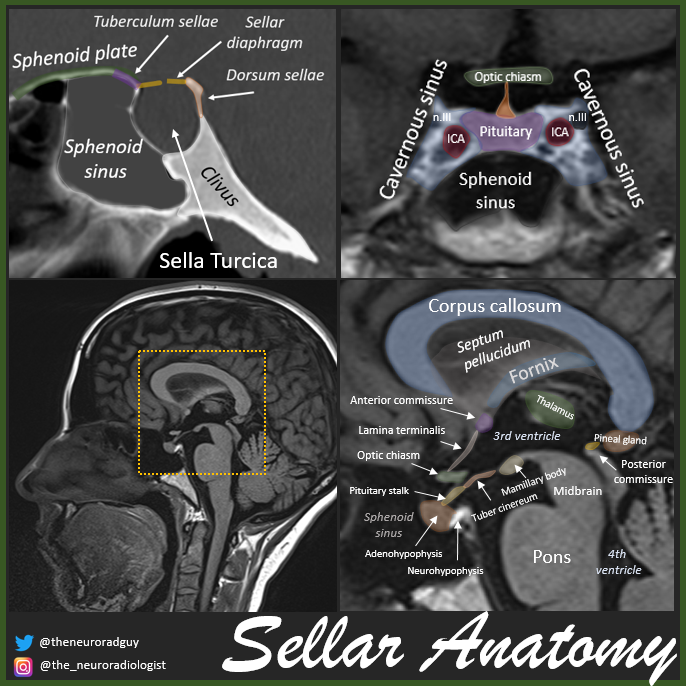 Sellar Anatomy is Stellar Anatomy! Just some screenshots from a presentation on pituitary imaging. #FoamRad #FOAMed #MedEd #RadEd #RadRes #hormones
