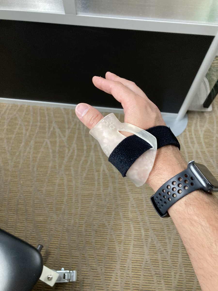 DrBrettCarey's tweet photo. Labor shortage = overuse injuries. Been making tons of thumb splints lately. Print material cost is $1.30. Would be great option for #developing-nations. @cast_print @3DPrintingUoft @Enablethefuture @desktophealth @Glia_Intl https://t.co/X7isxoRIuj