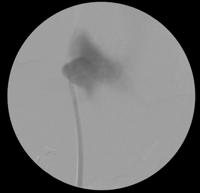 JHakmei's tweet photo. Femoral cath malfunction. Is that an aneurysm or dilated IVC? Never seen anything like that before. @ASDINNews @askrenal https://t.co/a3g6KYGHgi