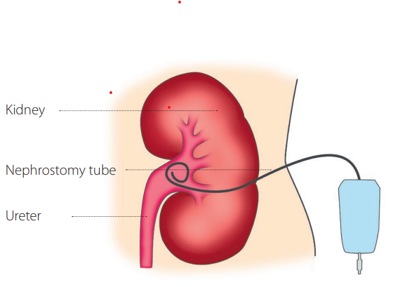 #hello #May #topicofthemonth #Kidney & #IR #ETF is back with its #topicofthemonth! 
Kidney stones may block the flow of urine and cause terrible pain in the side and back. Sometimes medication is not enough. cirse.org/wp-content/upl…