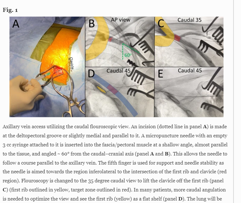 hhuang123's tweet photo. 🚨Hot off the press! Must read editorial in @JICE_EP by @FYang_EP &amp; @malyshevMD (+) step-by-step walk through of their unique axillary vein approach using caudal flouroscopic visualization
Read👇https://t.co/vdkaHic54k 
#Epeeps @rdschaller @JonPicciniSr @MDTolgaAksu @dr_pmueller https://t.co/TzeycI4DuX