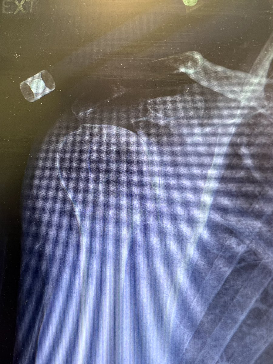 StressHoop's tweet image. I’m shocked that the 2 PRP injections that this patient got last year did not help. /s

I wonder if the Doctor that prescribed and injected them and charged cash for them feels like they did the right thing medically.